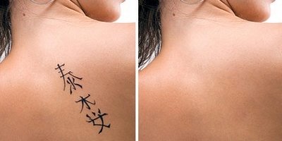 Иссечение татуировки