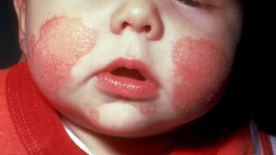 Тяжелая патология кожи - мокнущий дерматит