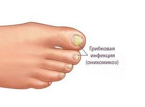 Онихомикоз - грибок ногтей