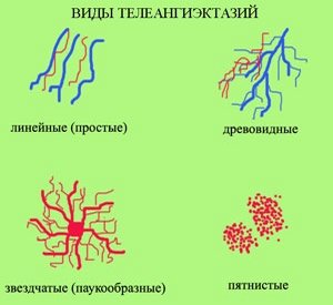 Основные разновидности форм телеангиэктазий