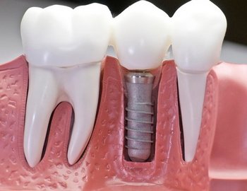 Установленный зубной имплантат