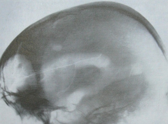 Рентгеновский снимок фронто-базального перелома с травматической пневмоцефалией в боковой проекции