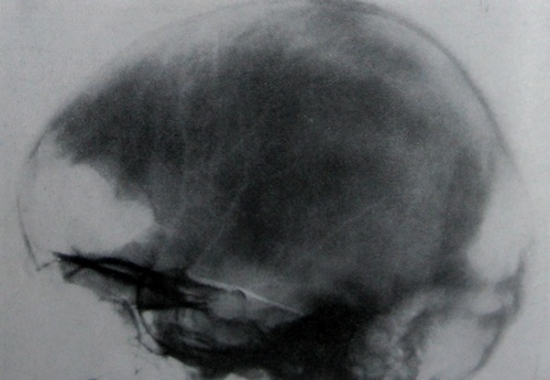 Рентгеновский снимок в боковой проекции лобно-височно-базального перелома с повреждением канала зрительного нерва