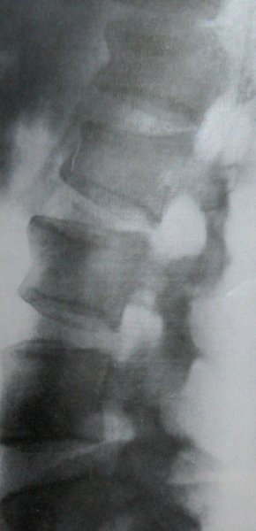 Рентгеновский снимок множественных переломов поясничных позвонков в боковой проекции