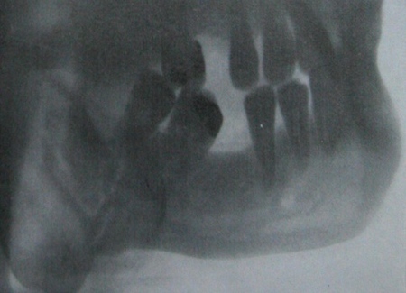 Прицельный рентгеновский снимок оскольчатого перелома нижней челюсти в боковой проекции