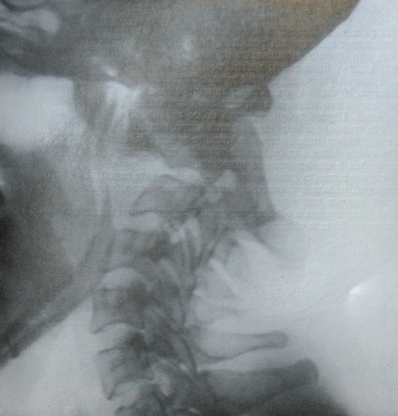 Боковой рентгеновский снимок переднего вывиха атланта с отломом зуба эпистрофея