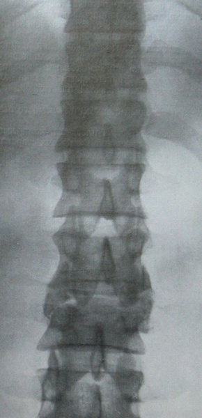 Рентгеновский снимок перелома 3 поясничного позвонка с вывихом 2 позвонка в задней проекции