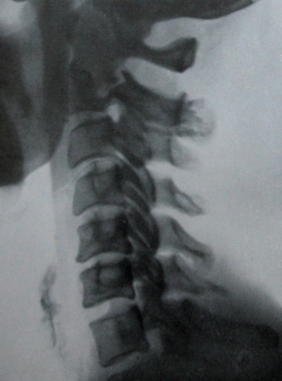 Рентгеновский снимок перелома дуги эпистрофея в боковой проекции