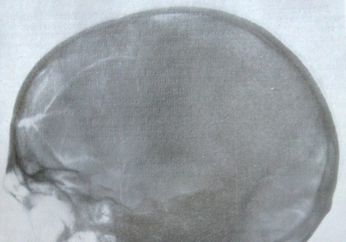 Рентгеновский снимок перелома лобной, клиновидной и височной костей с переломом основания черепа в боковой проекции