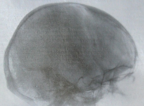 Боковой рентгеновский снимок перелома затылочной кости