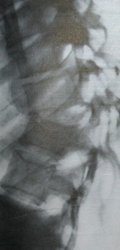 Боковой рентгеновский снимок переломо-вывиха 7, 8 и 9 грудных позвонков