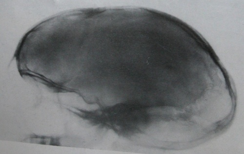 Боковой рентгеновский снимок продольного перелома черепа с расхождением стреловидного шва