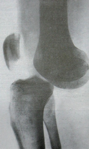 Рентгеновский снимок вывиха коленного сустава в боковой проекции