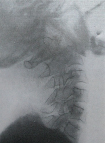 Рентгеновский снимок в боковой проекции заднего вывиха атланта с переломом зуба эпистрофея