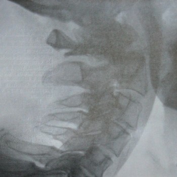 Боковой снимок компрессионного переломо-вывиха атланта