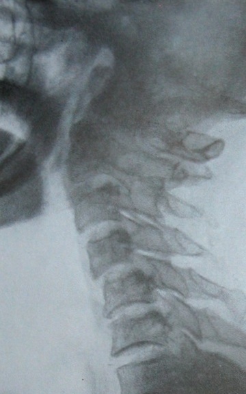 Боковой рентгеновский снимок переломо-вывиха атланта и эпистрофея с переломом остистого отростка 3 шейного позвонка