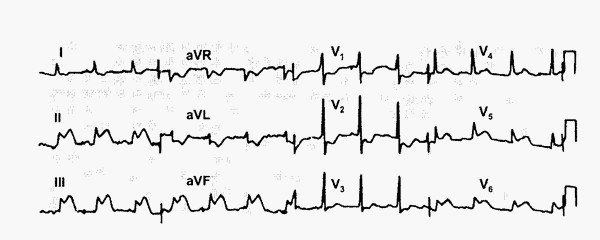 ЭКГ при инфаркте миокарда с подъемом ST, обусловленном окклюзией правой коронарной артерии