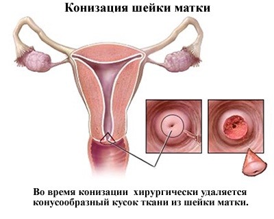 Конизация рака шейки матки
