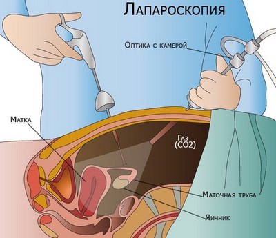 Использование лапароскопии в гинекологии