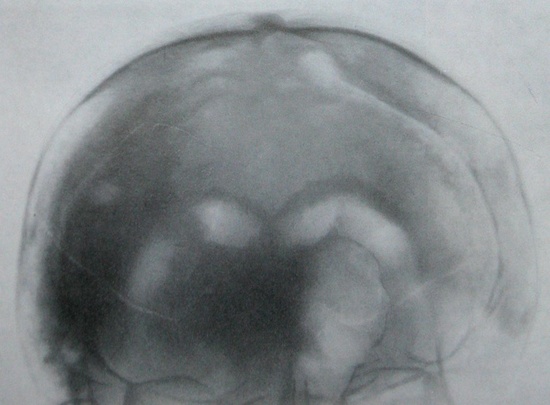 Рентгеновский снимок фронто-базального перелома с травматической пневмоцефалией в передней проекции