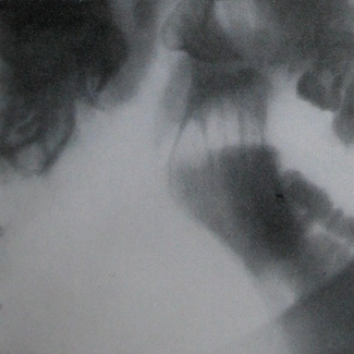 Первый рентгеновский снимок переломо-вывиха нижней челюсти в боковой проекции