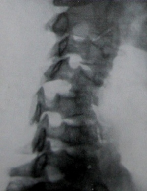 Рентгеновский снимок вывиха 4 шейного позвонка в правой полукосой проекции