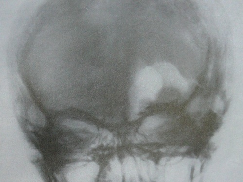 Рентгеновский снимок в прямой проекции лобно-височно-базального перелома с повреждением канала зрительного нерва