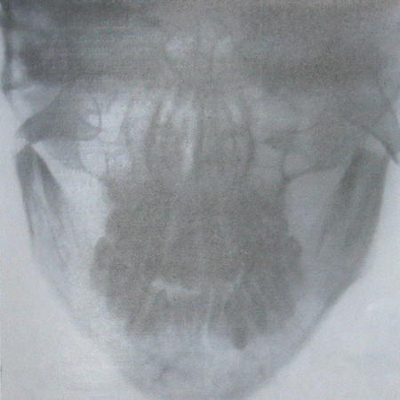 Рентгеновский снимок переломо-вывиха нижней челюсти в прямой проекции