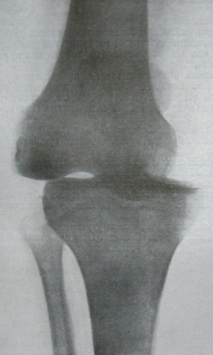 Рентгеновский снимок вывиха коленного сустава в прямой проекции