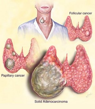 Разновидности рака щитовидной железы