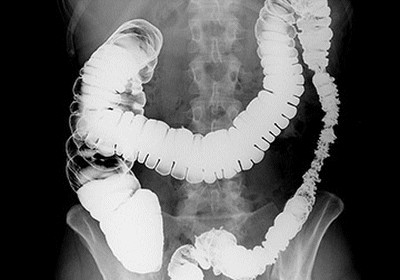 Рентген толстого кишечника с контрастированием