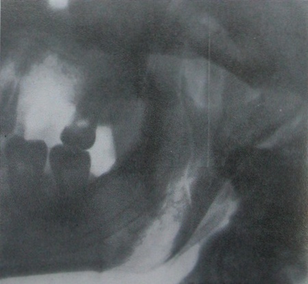 Рентгеновский снимок оскольчатого перелома ветви нижней челюсти в боковой проекции