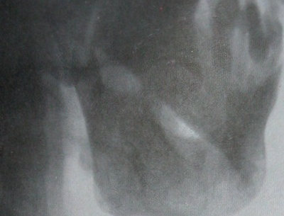 Изолированный вывих нижней челюсти на рентгеновском снимке