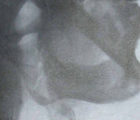Рентгеновский снимок оскольчатого перелома ветви нижней челюсти: Пострадавший сидит