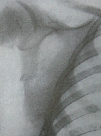 Рентгеновский снимок перелома тела лопатки у 12-летнего ребенка