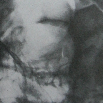 Рентгеновский снимок лобно-височно-базального перелома с повреждением канала зрительного нерва сделанный по методике Резе