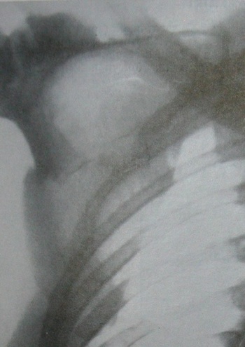 Рентгеновский снимок поперечного перелома средней трети тела лопатки