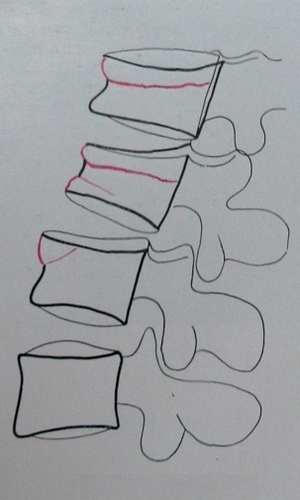 Схема к рентгеновскому снимку множественных переломов поясничных позвонков в боковой проекции