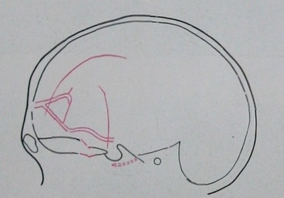Схема к рентгеновскому снимку перелома лобной, клиновидной и височной костей с переломом основания черепа в боковой проекции
