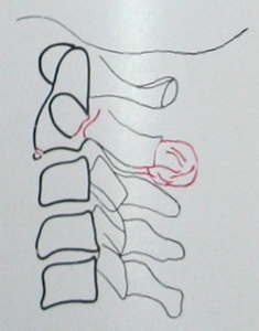 Схема к рентгеновскому снимку в боковой проекции перелома дуги эпистрофея
