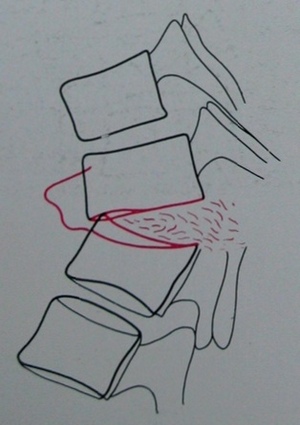Схема к боковому рентгеновскому снимку переломо-вывиха 7, 8 и 9 грудных позвонков