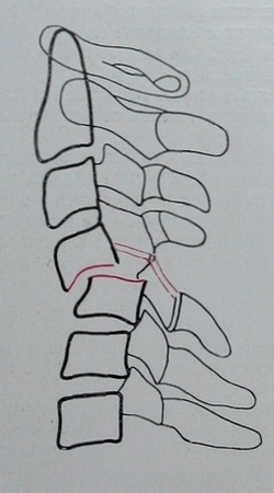 Схема к рентгеновскому снимку вывиха 4 шейного позвонка в боковой проекции