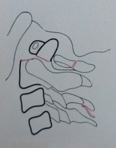 Схема к боковому рентгеновскому снимку переломо-вывиха атланта и эпистрофея с переломом остистого отростка 3 шейного позвонка