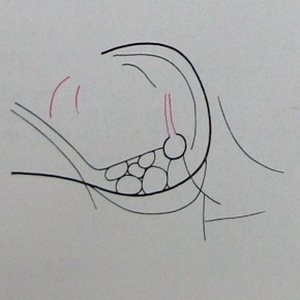 Схема к рентгеновскому снимку по Резе лобно-височно-базального перелома с повреждением канала зрительного нерва