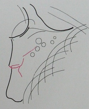Схема к снимку перелома тела лопатки у 12-летнего ребенка