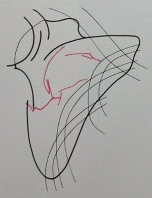 Схема к снимку поперечного перелома средней трети тела лопатки