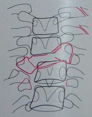 Схема к заднему рентгеновскому снимку переломо-вывиха 7, 8 и 9 грудных позвонков