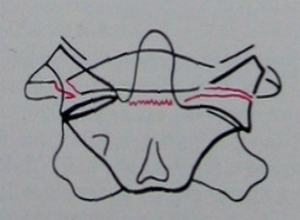 Схема к заднему снимку компрессионного переломо-вывиха атланта