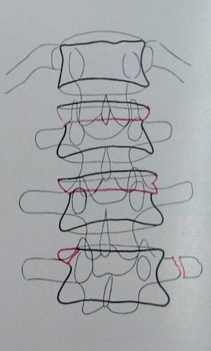 Схема к рентгеновскому снимку множественных переломов поясничных позвонков в задней проекции