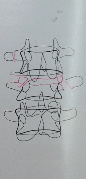 Схема к рентгеновскому снимку перелома 3 поясничного позвонка с вывихом 2 позвонка в задней проекции